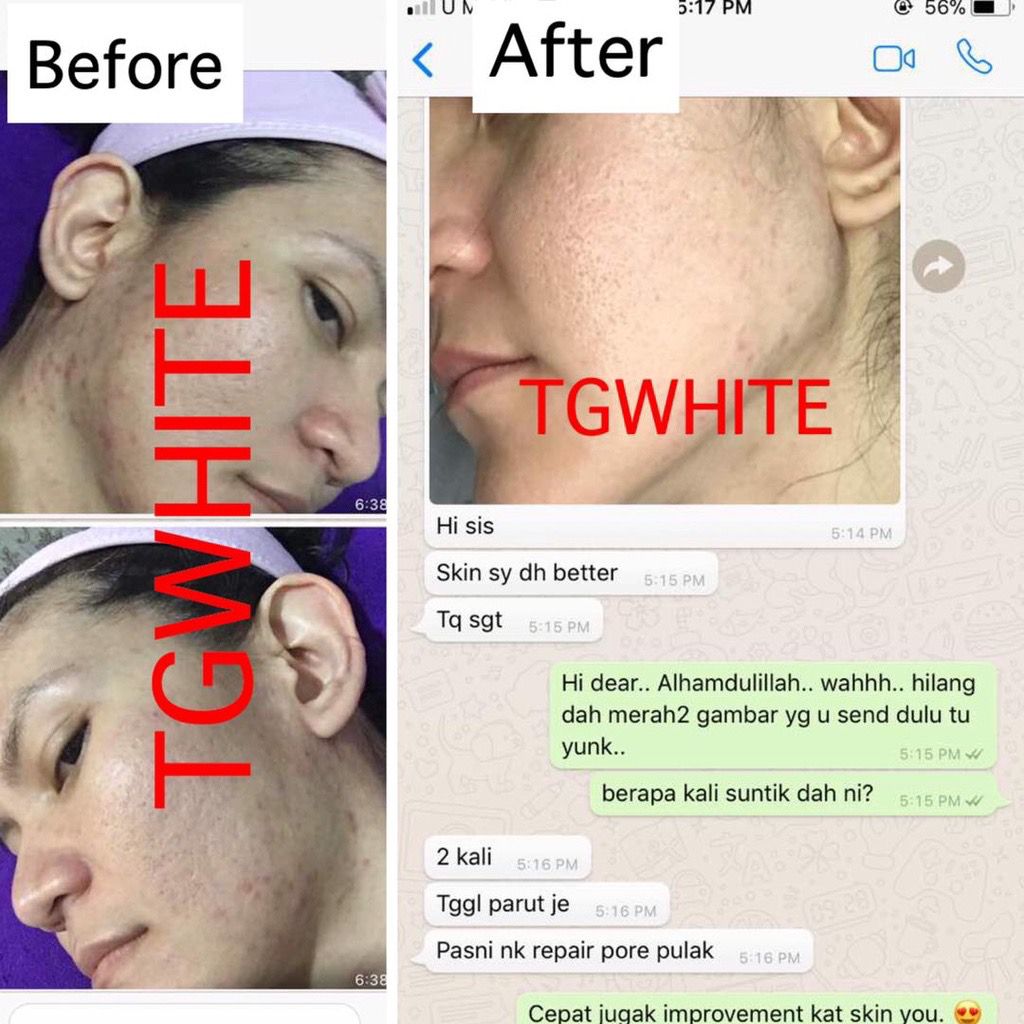 TG White Full Set
